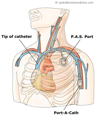 porta catheter placement
